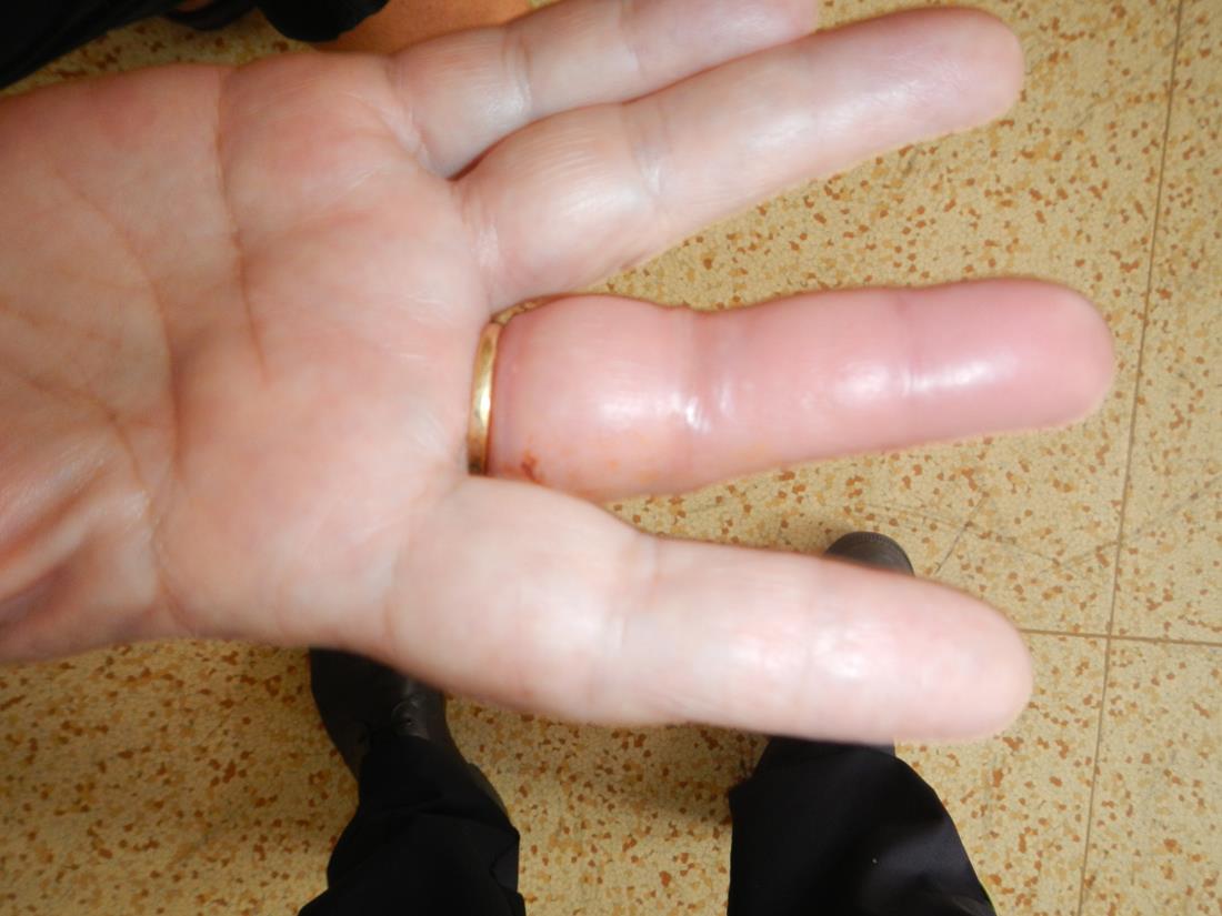 2 Odstranění prstenu +vosí štípnutí, Týn nad Vltavou - 24. 8. 2015 (2).jpg